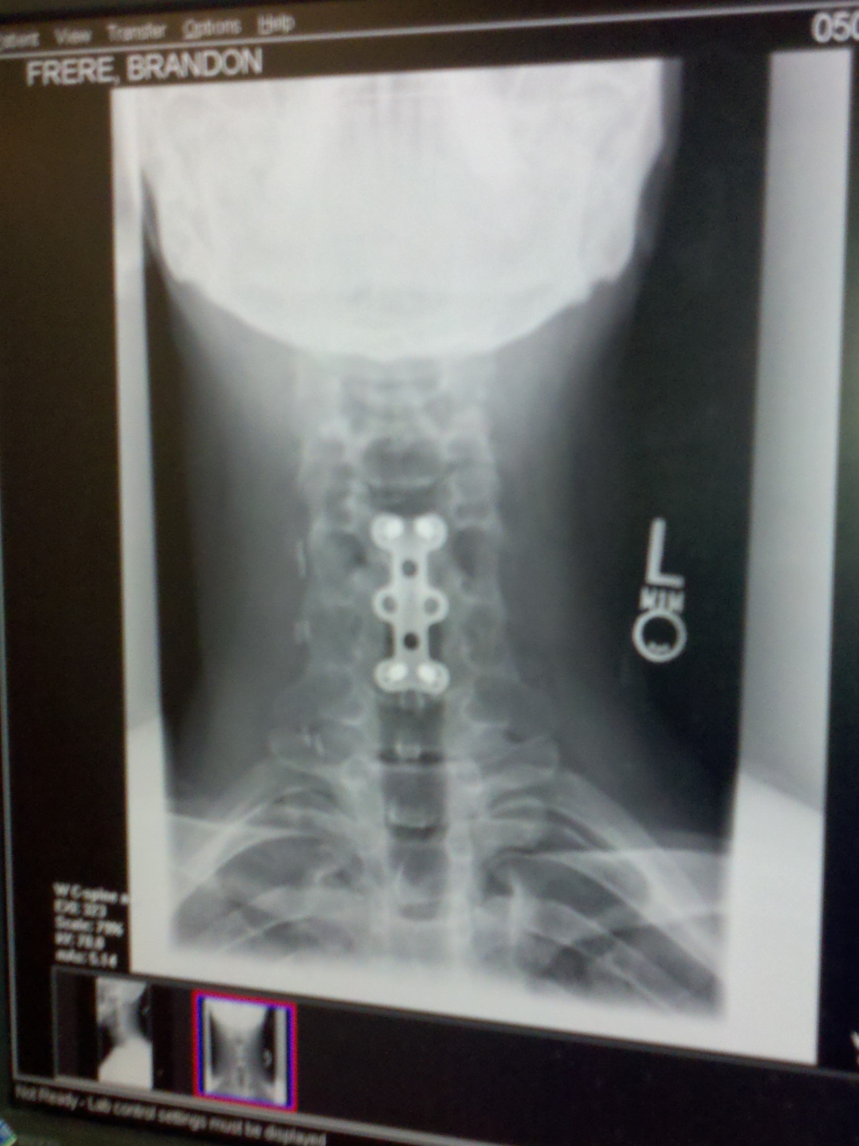 X-ray of Brandon’s neck after surgery from a crush burst fracture to his C5